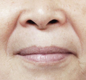 Nasolabial Folds